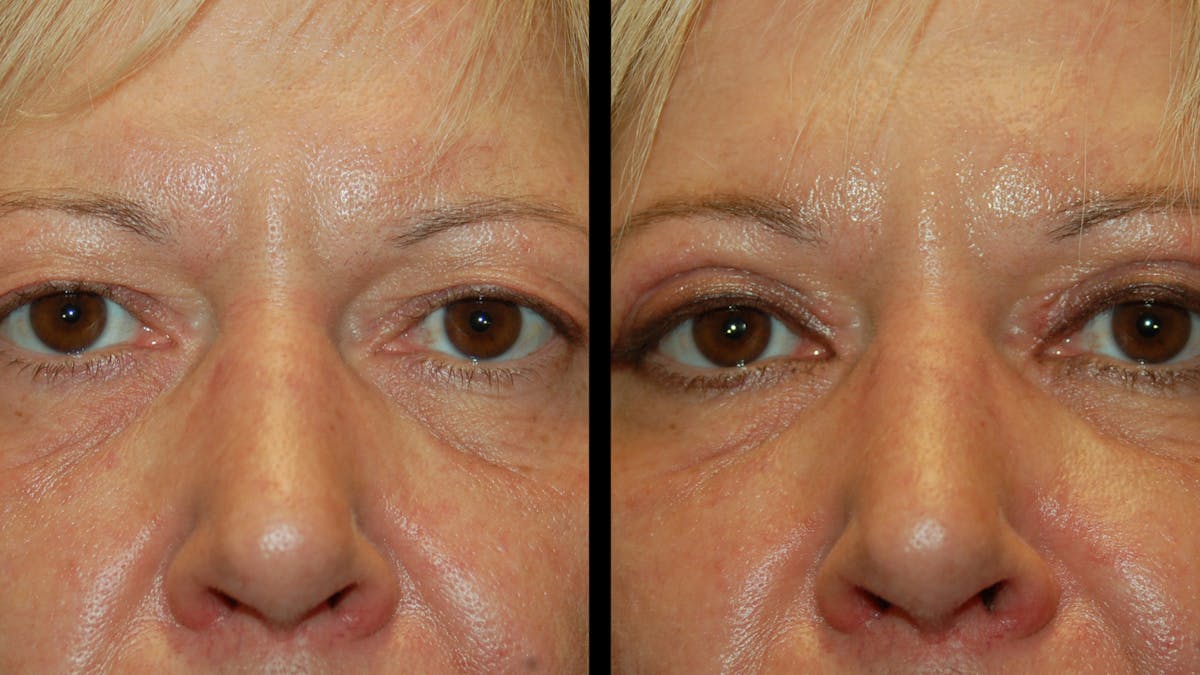 Upper Eyelid Surgery Before & After Gallery - Patient 312629 - Image 6