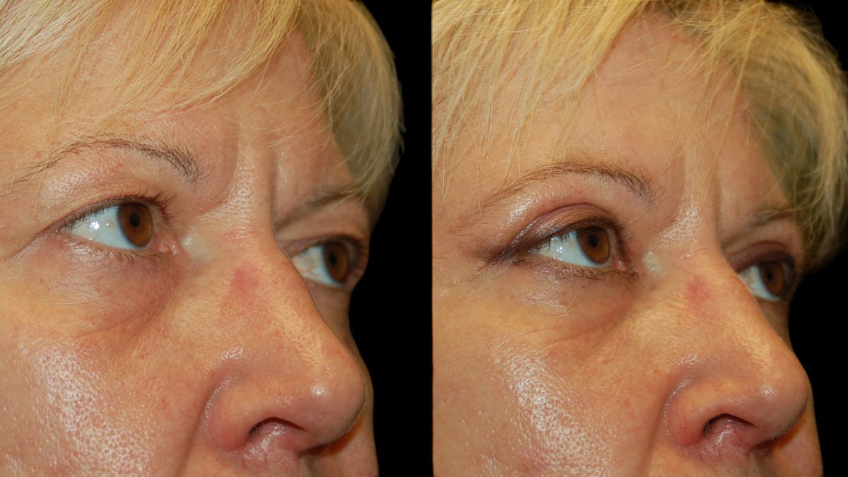 Upper Eyelid Surgery Before & After Gallery - Patient 312629 - Image 7