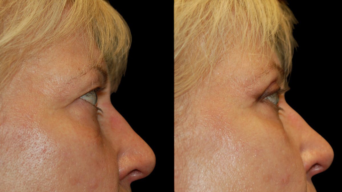 Upper Eyelid Surgery Before & After Gallery - Patient 312629 - Image 8