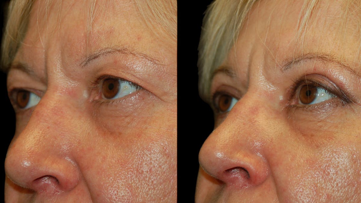 Upper Eyelid Surgery Before & After Gallery - Patient 312629 - Image 9
