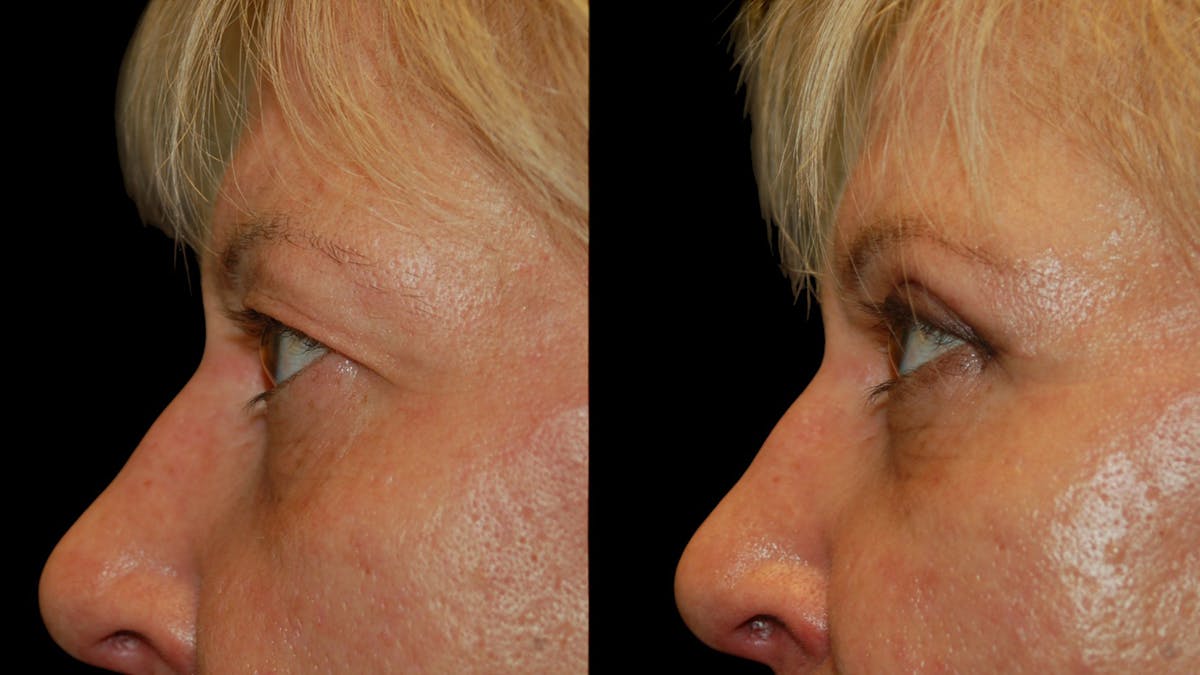 Upper Eyelid Surgery Before & After Gallery - Patient 312629 - Image 10