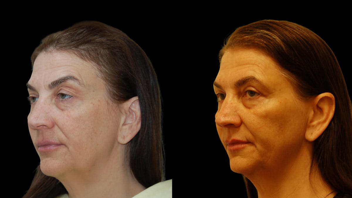 Upper Eyelid Surgery Before & After Gallery - Patient 369967 - Image 2