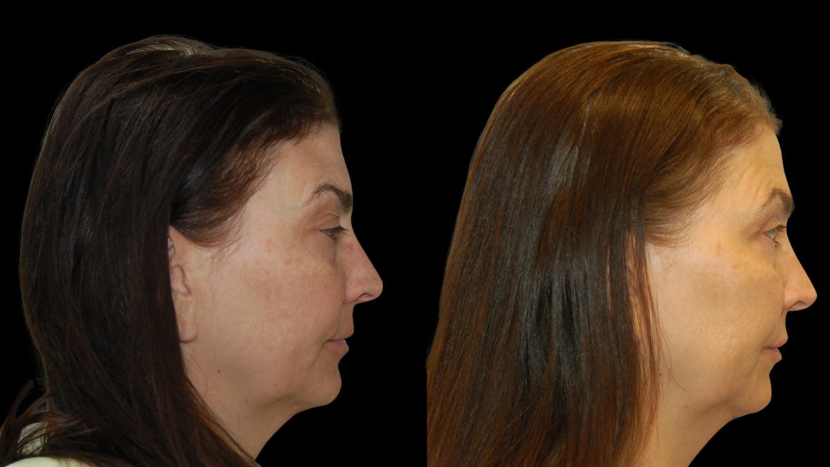 Upper Eyelid Surgery Before & After Gallery - Patient 369967 - Image 3