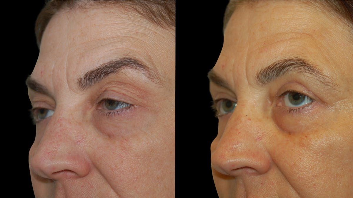 Upper Eyelid Surgery Before & After Gallery - Patient 369967 - Image 4