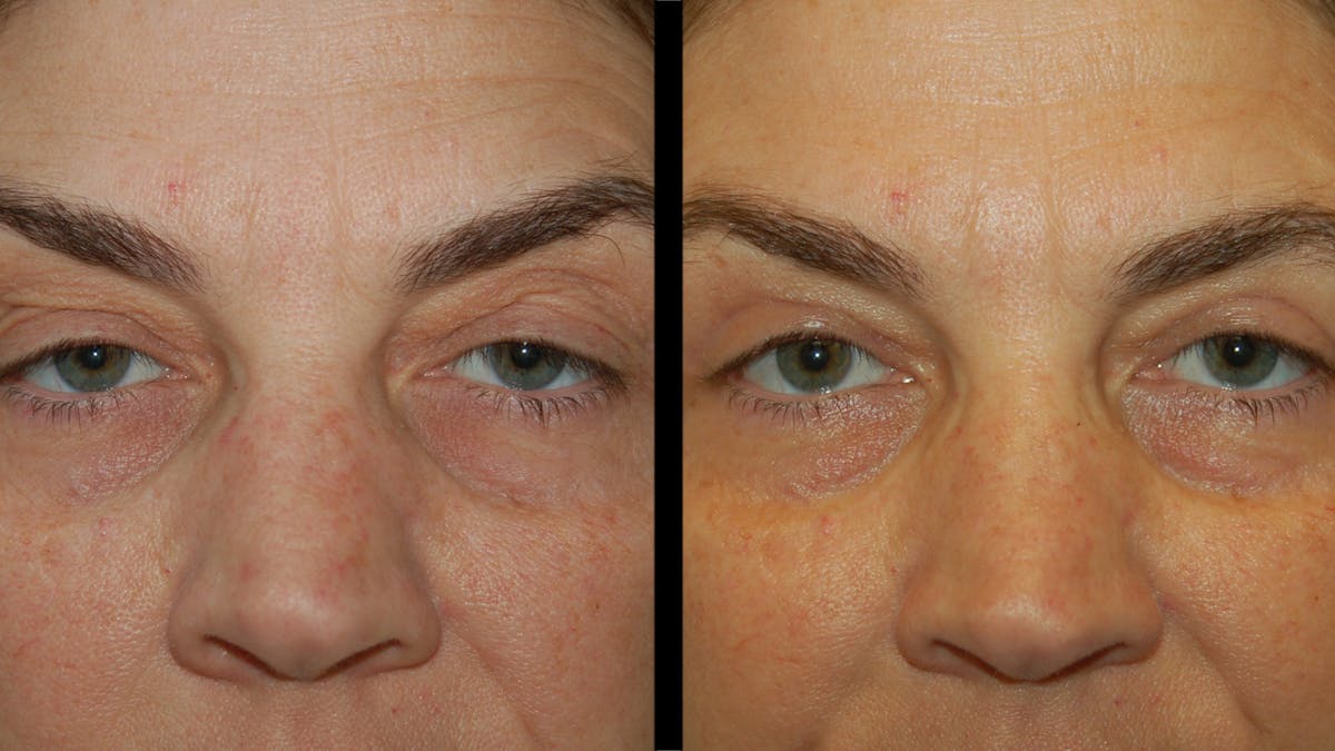 Upper Eyelid Surgery Before & After Gallery - Patient 369967 - Image 5