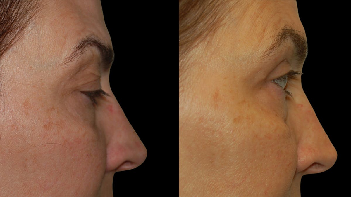 Upper Eyelid Surgery Before & After Gallery - Patient 369967 - Image 6