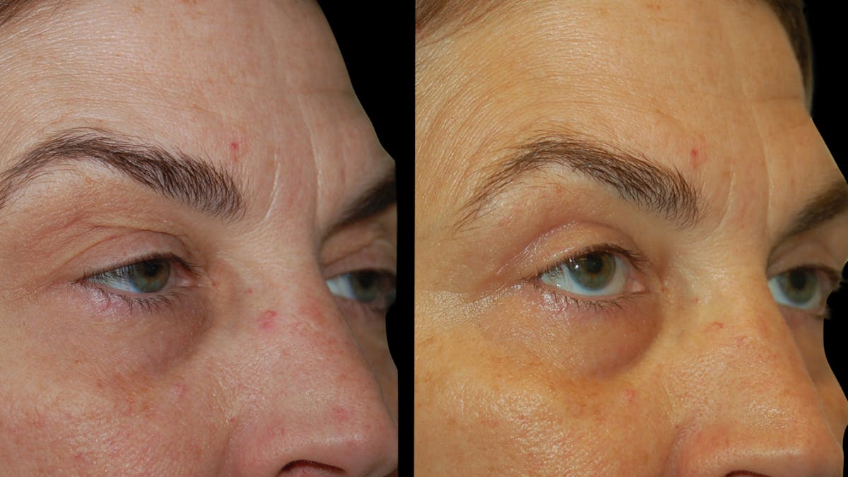 Upper Eyelid Surgery Before & After Gallery - Patient 369967 - Image 7