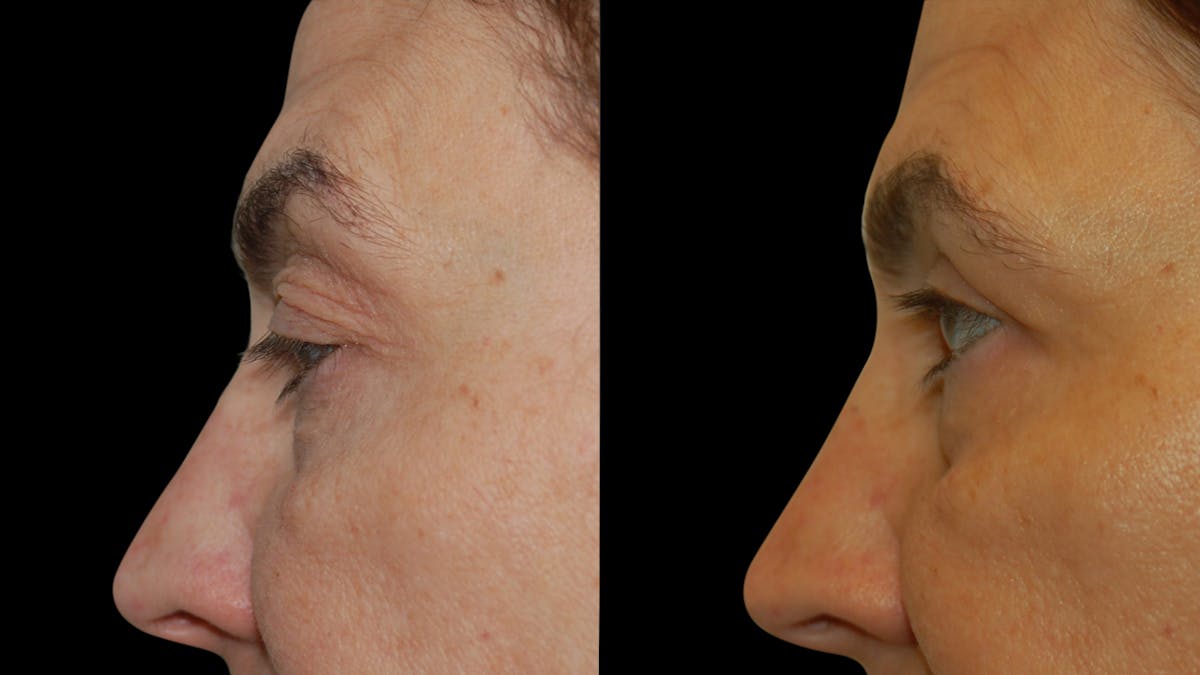 Upper Eyelid Surgery Before & After Gallery - Patient 369967 - Image 8