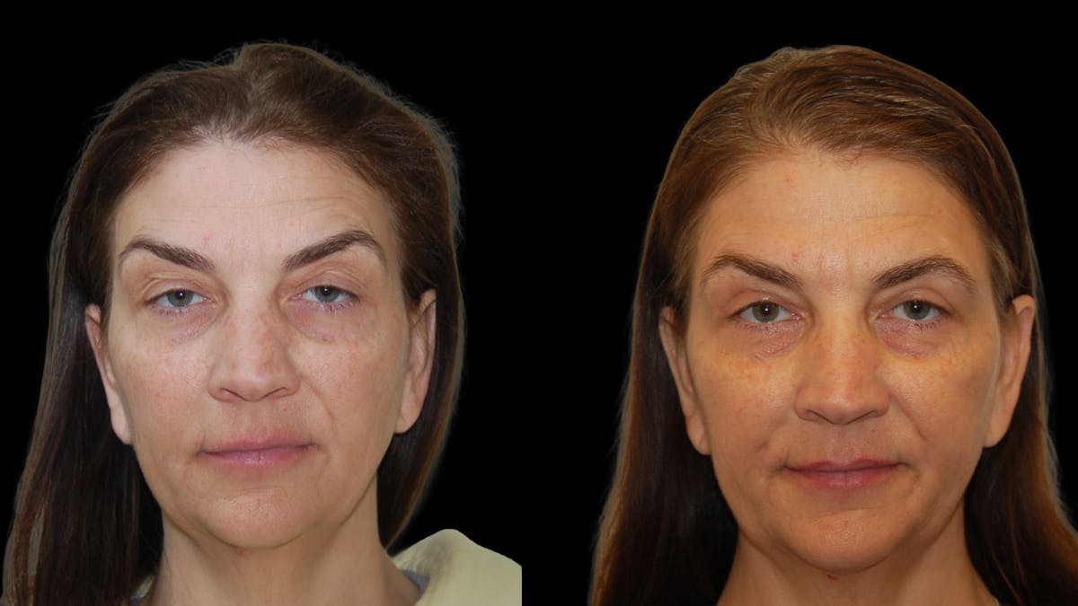 Upper Eyelid Surgery Before & After Gallery - Patient 369967 - Image 1