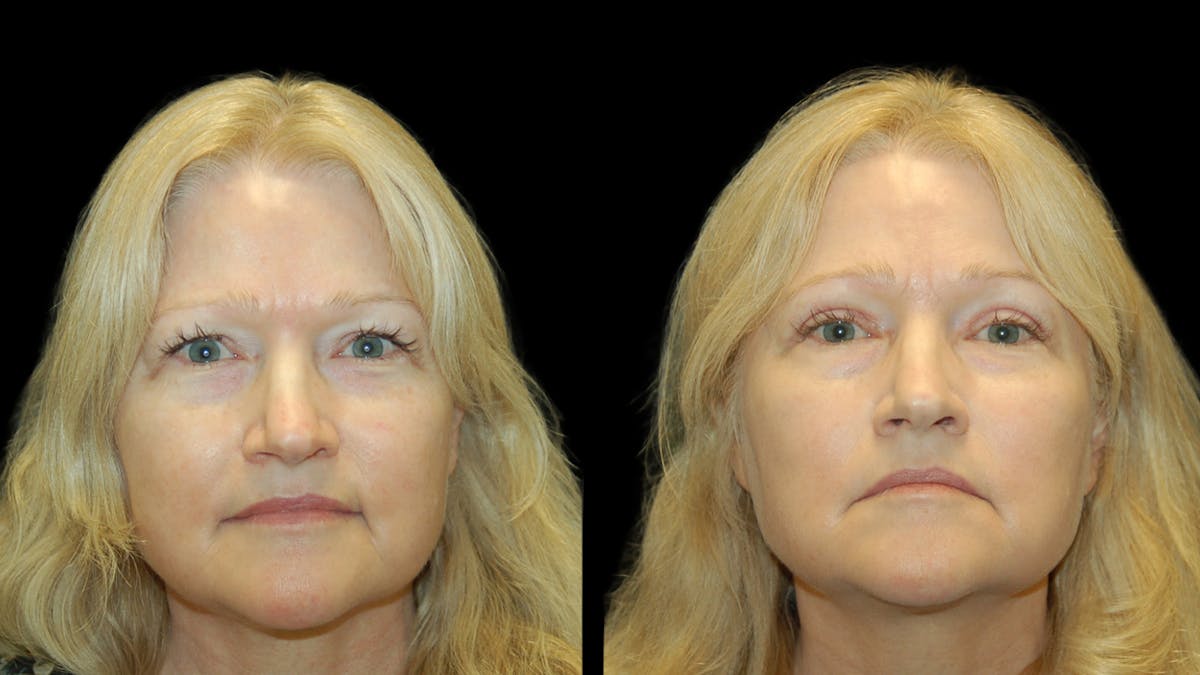 Upper Eyelid Surgery Before & After Gallery - Patient 256622 - Image 1