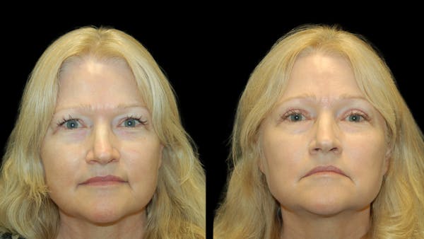 Upper Eyelid Surgery Before & After Gallery - Patient 256622 - Image 1