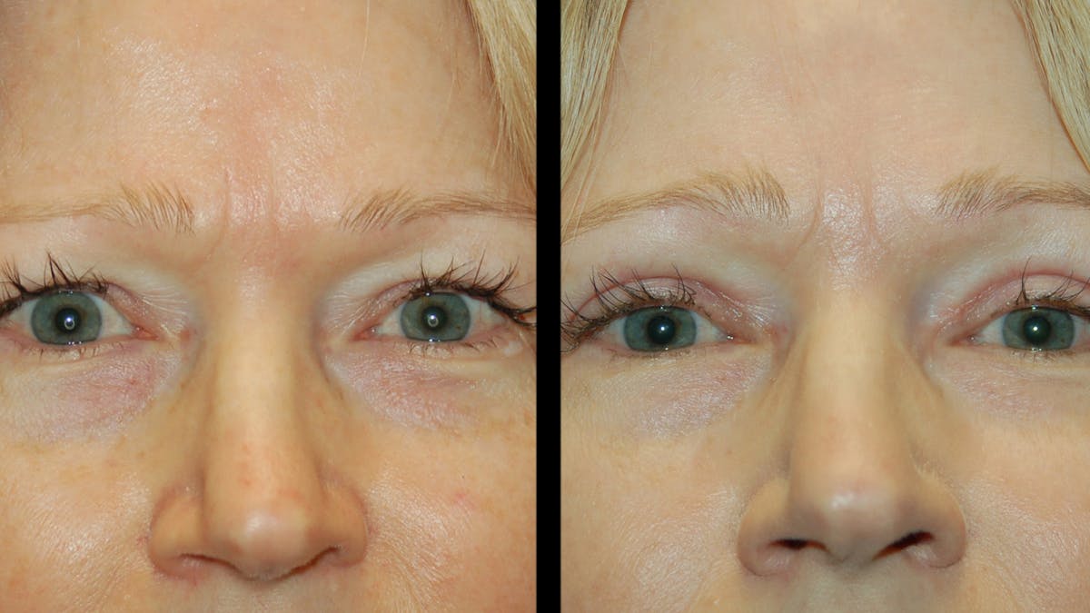 Upper Eyelid Surgery Before & After Gallery - Patient 256622 - Image 2