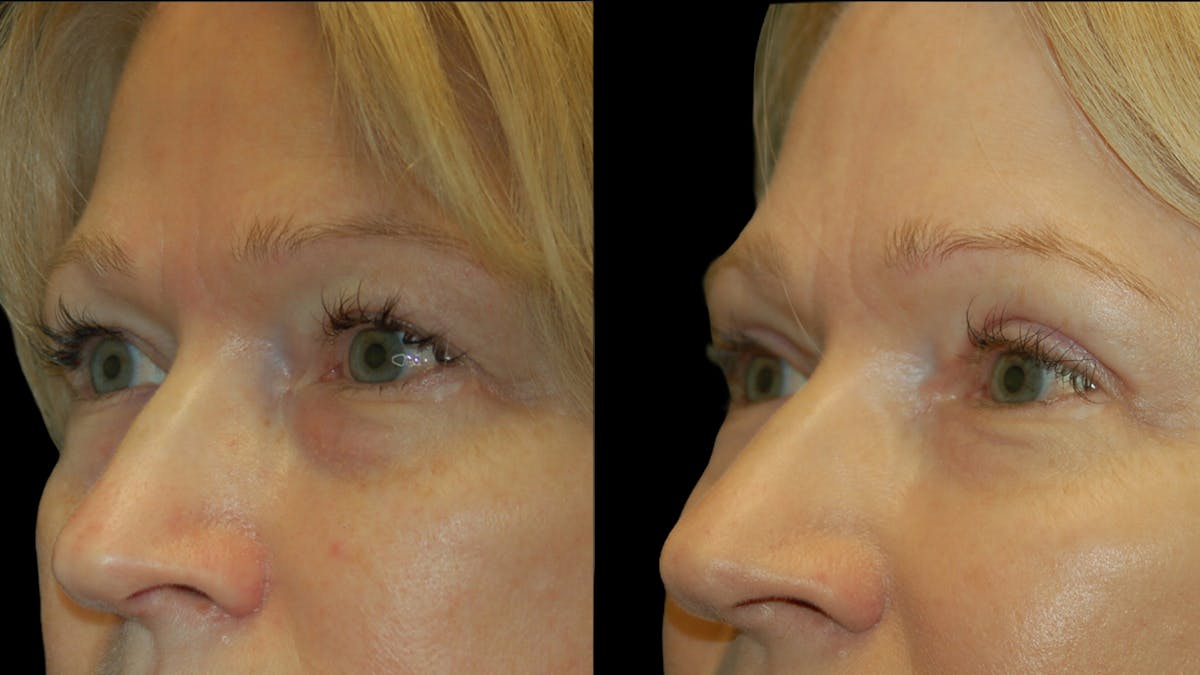 Upper Eyelid Surgery Before & After Gallery - Patient 256622 - Image 3