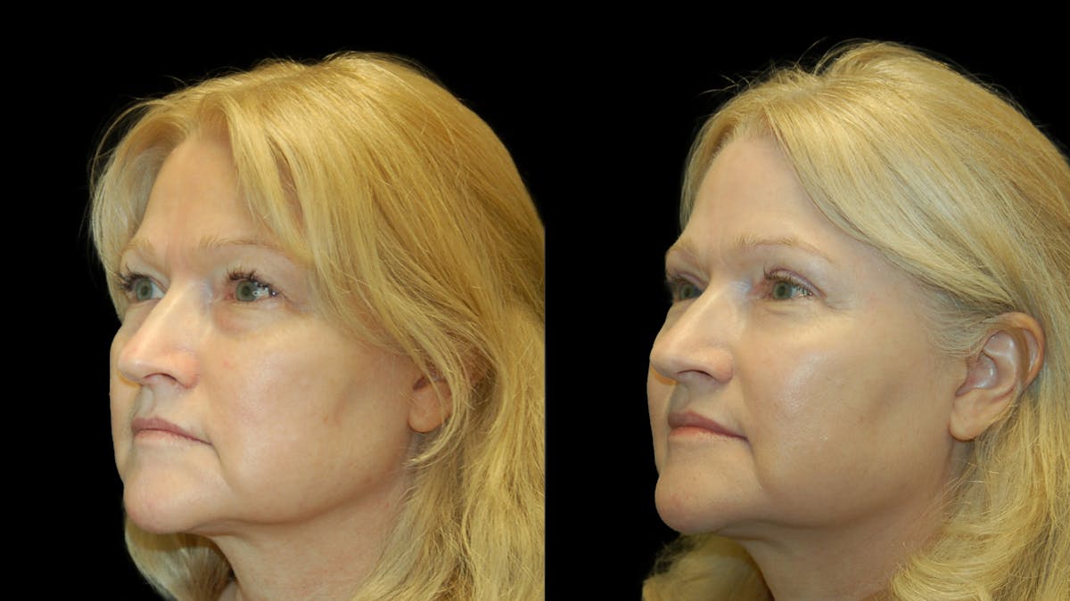 Upper Eyelid Surgery Before & After Gallery - Patient 256622 - Image 4