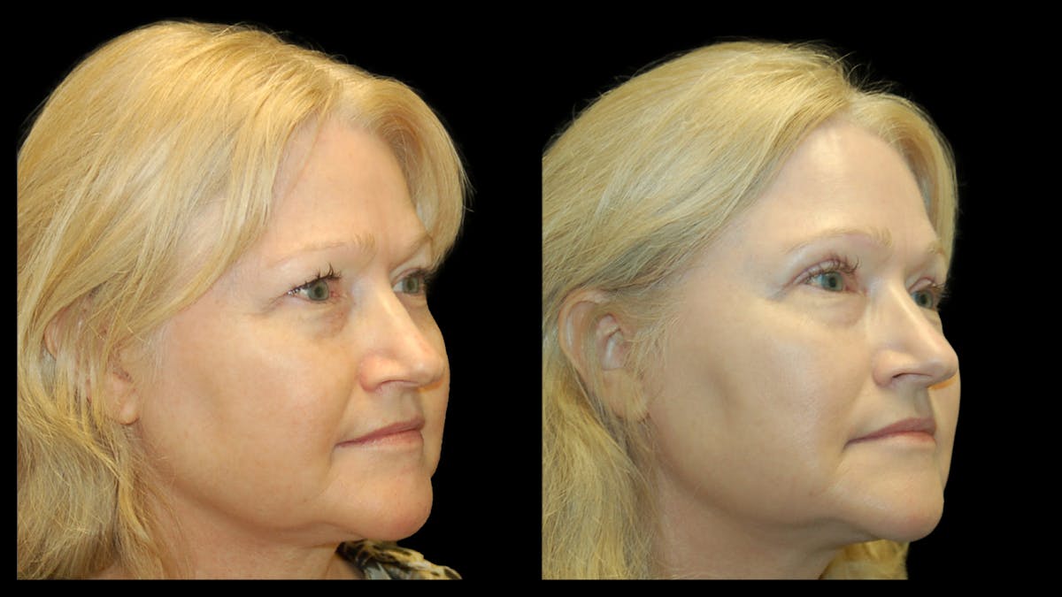Upper Eyelid Surgery Before & After Gallery - Patient 256622 - Image 5