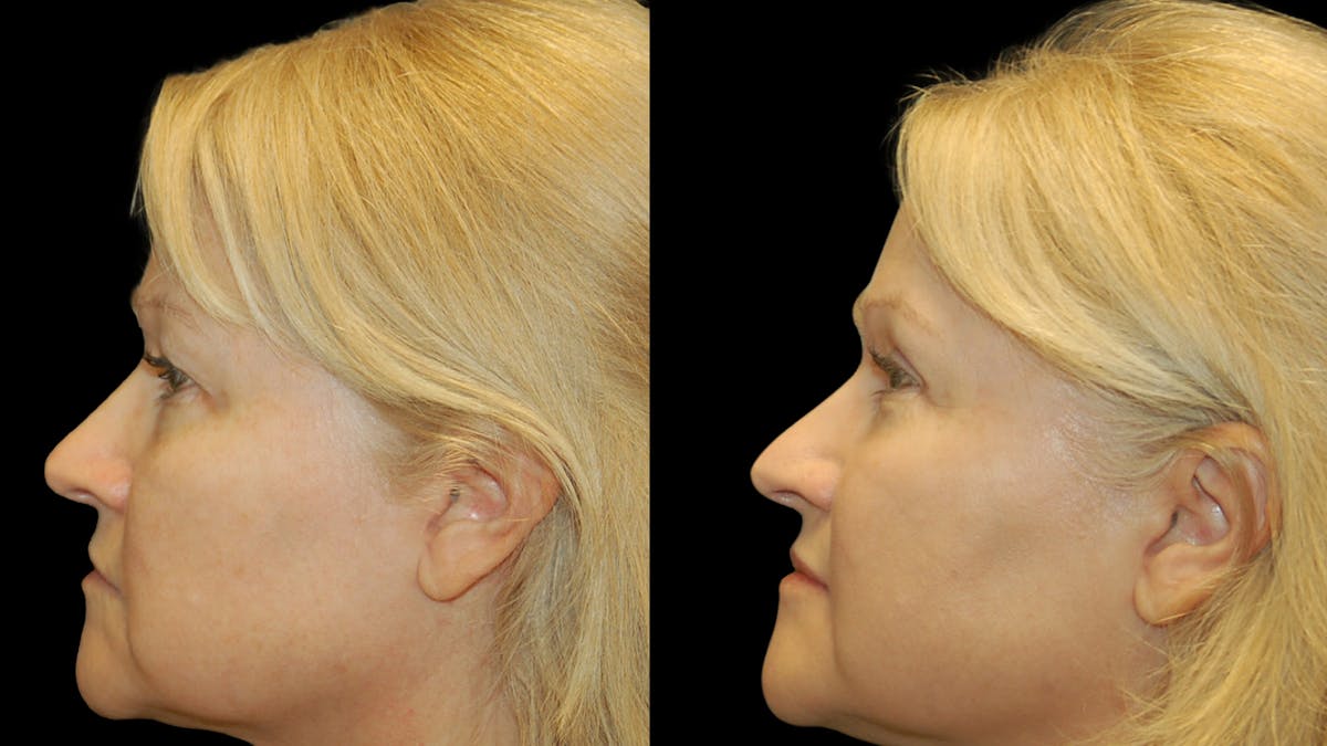 Upper Eyelid Surgery Before & After Gallery - Patient 256622 - Image 6
