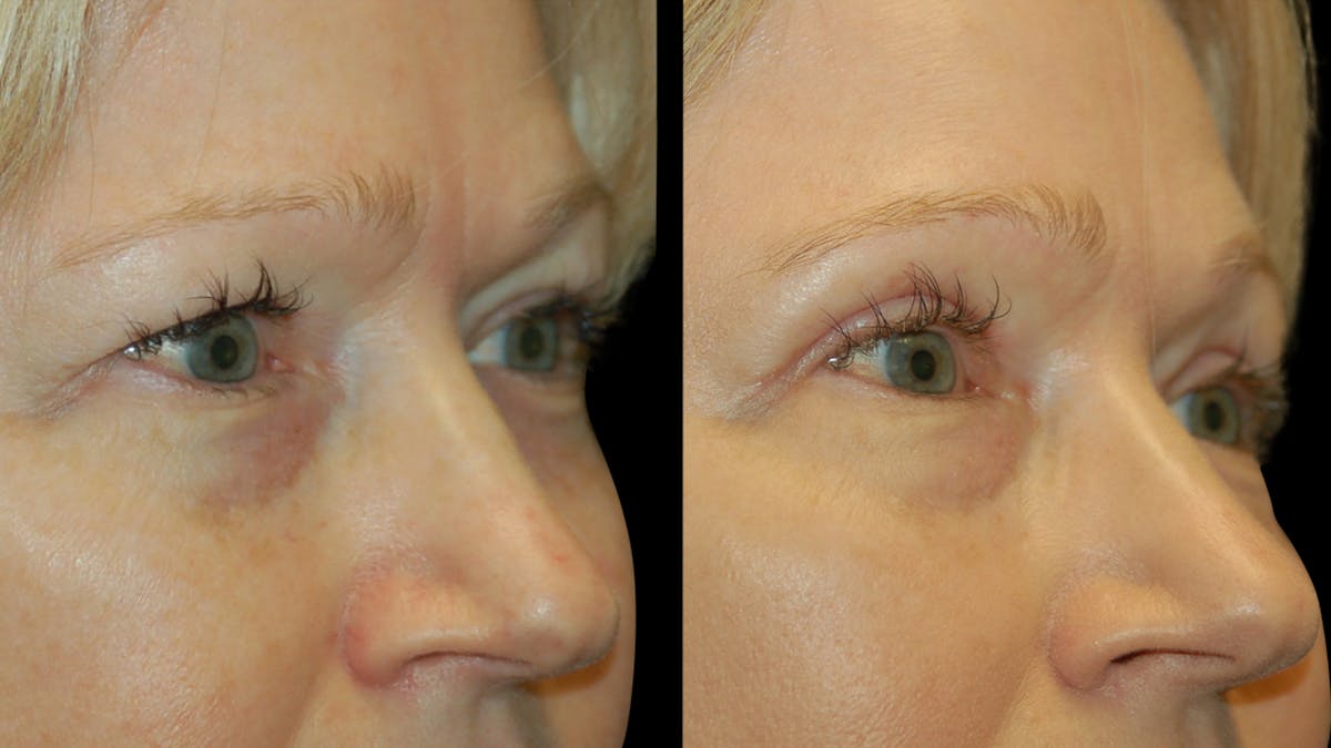 Upper Eyelid Surgery Before & After Gallery - Patient 256622 - Image 7