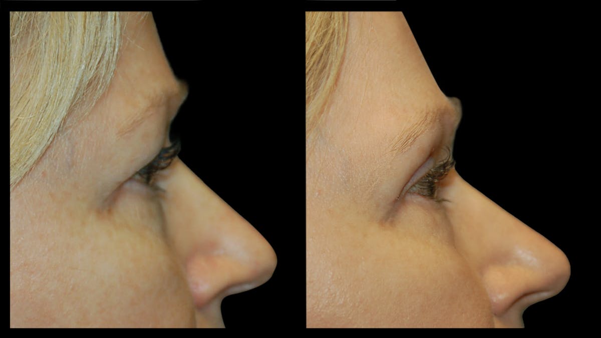 Upper Eyelid Surgery Before & After Gallery - Patient 256622 - Image 8