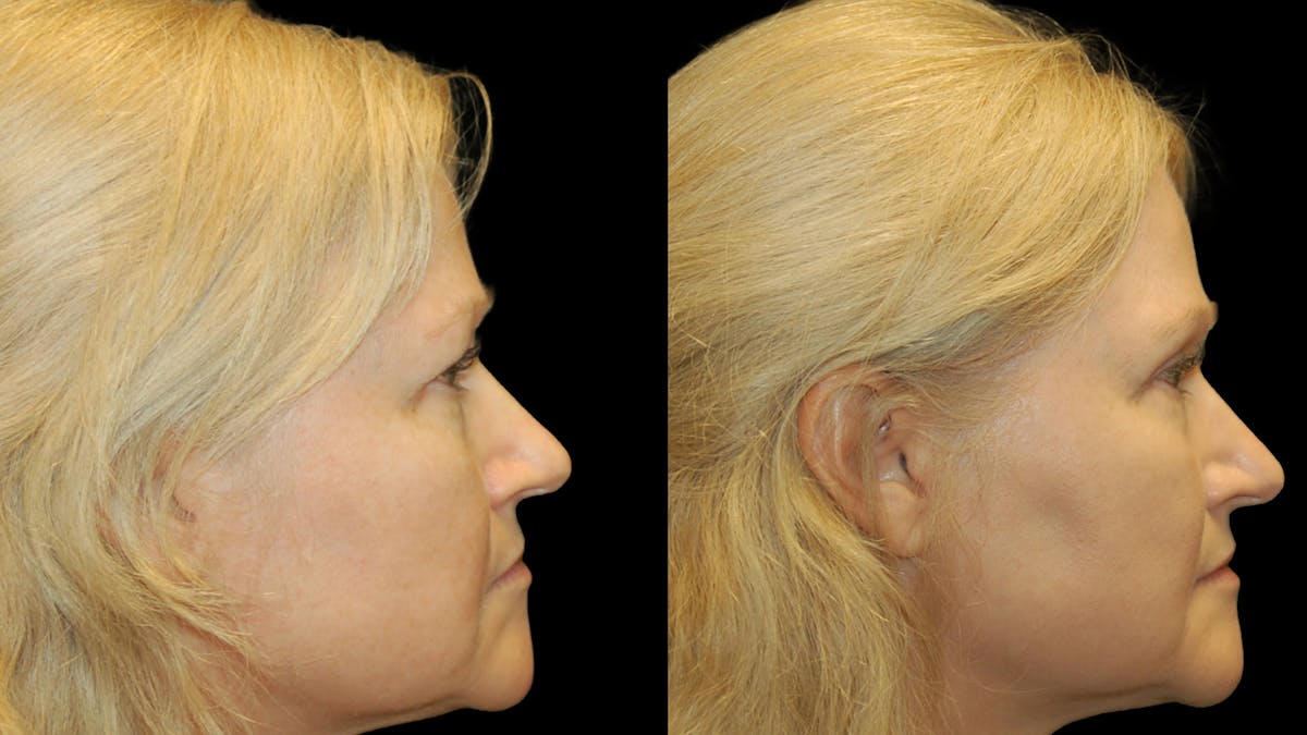 Upper Eyelid Surgery Before & After Gallery - Patient 256622 - Image 9