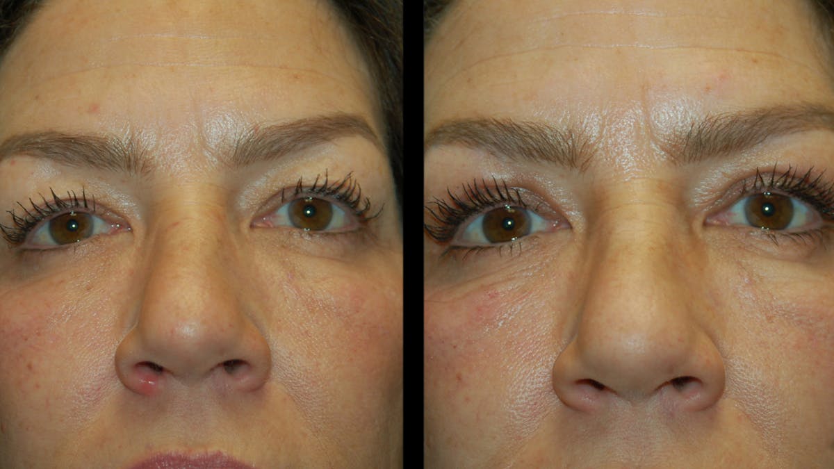 Upper Eyelid Surgery Before & After Gallery - Patient 237347 - Image 4