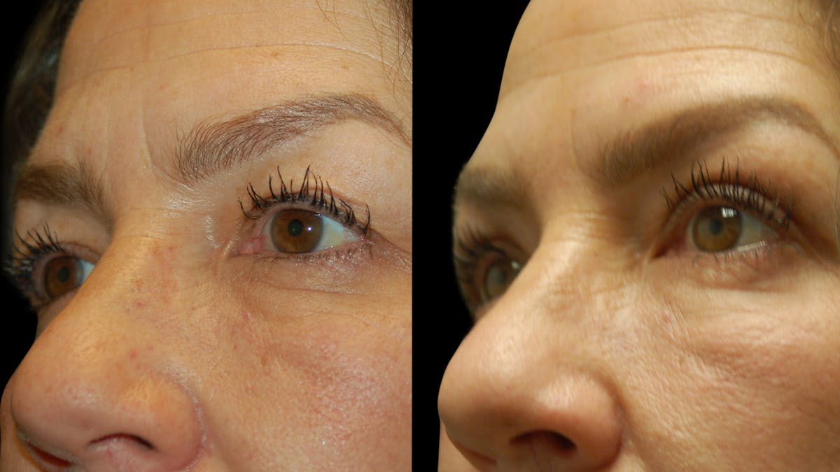 Upper Eyelid Surgery Before & After Gallery - Patient 237347 - Image 5