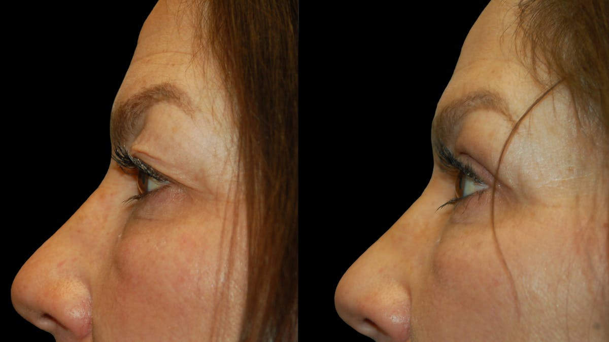 Upper Eyelid Surgery Before & After Gallery - Patient 237347 - Image 6