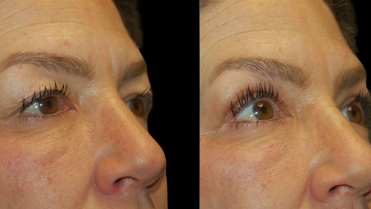 Upper Eyelid Surgery Before & After Gallery - Patient 237347 - Image 7