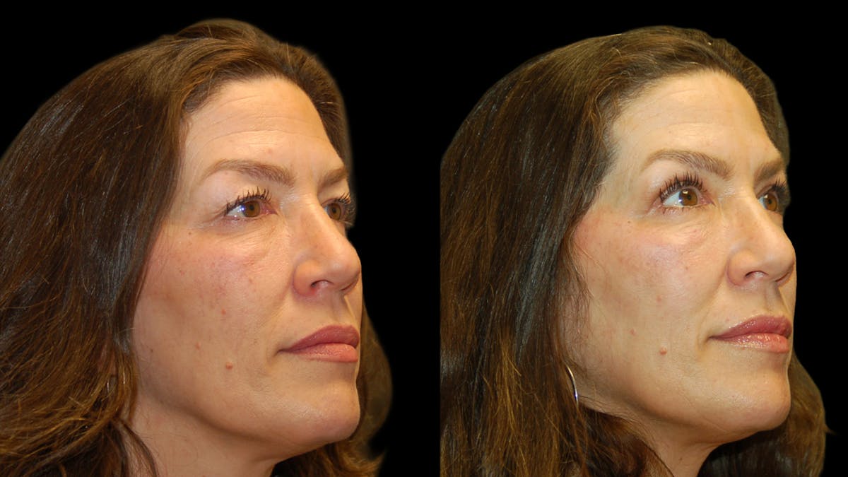 Upper Eyelid Surgery Before & After Gallery - Patient 237347 - Image 2