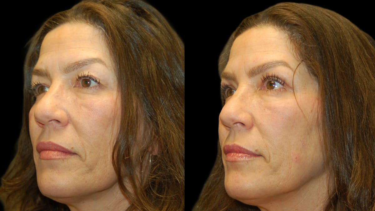 Upper Eyelid Surgery Before & After Gallery - Patient 237347 - Image 1