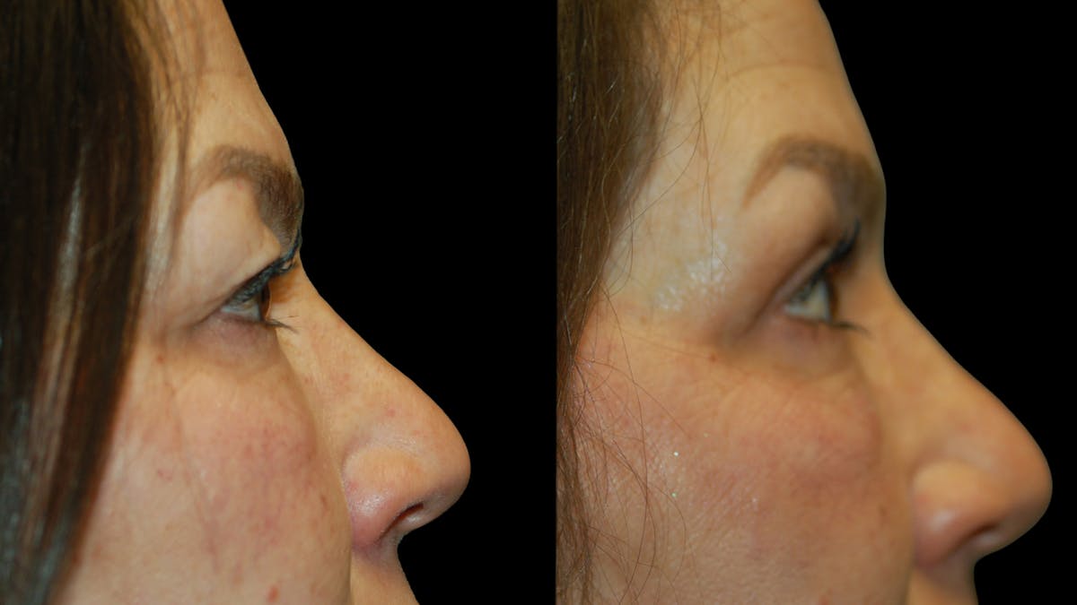 Upper Eyelid Surgery Before & After Gallery - Patient 237347 - Image 8