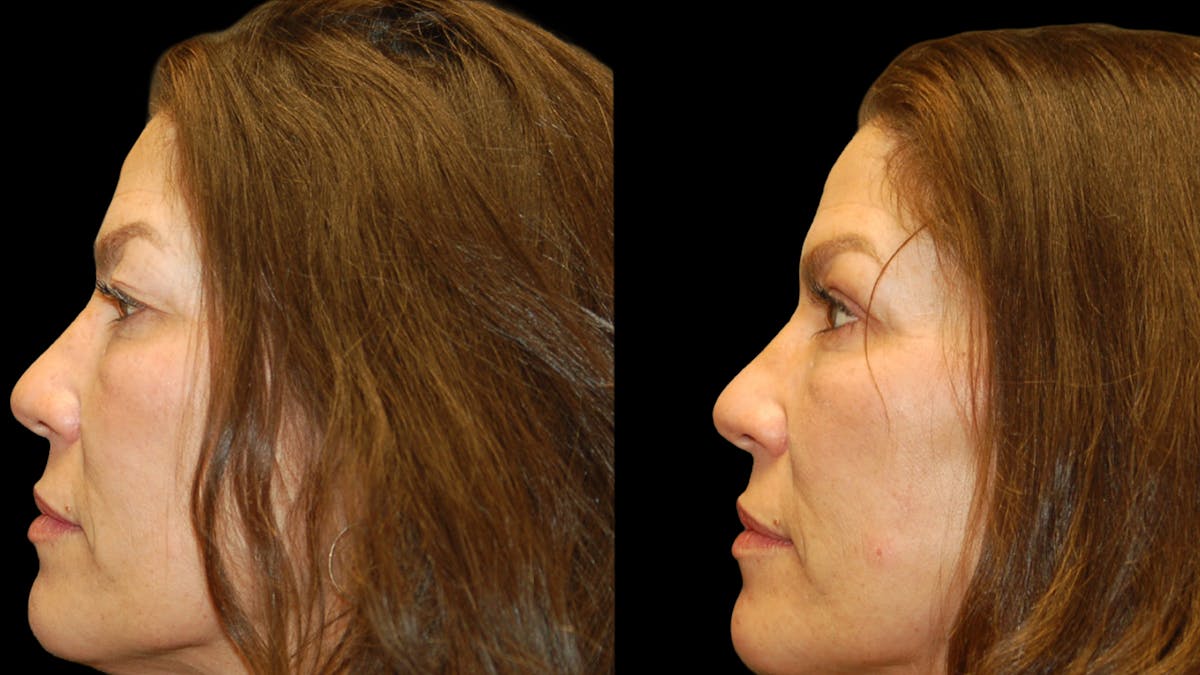 Upper Eyelid Surgery Before & After Gallery - Patient 237347 - Image 3