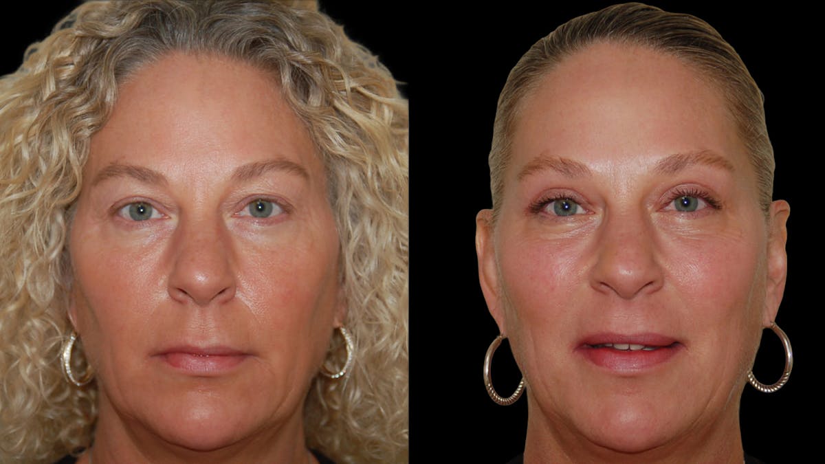 Upper Eyelid Surgery Before & After Gallery - Patient 556963 - Image 1