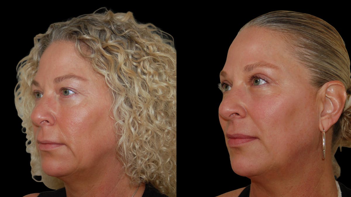 Upper Eyelid Surgery Before & After Gallery - Patient 556963 - Image 2