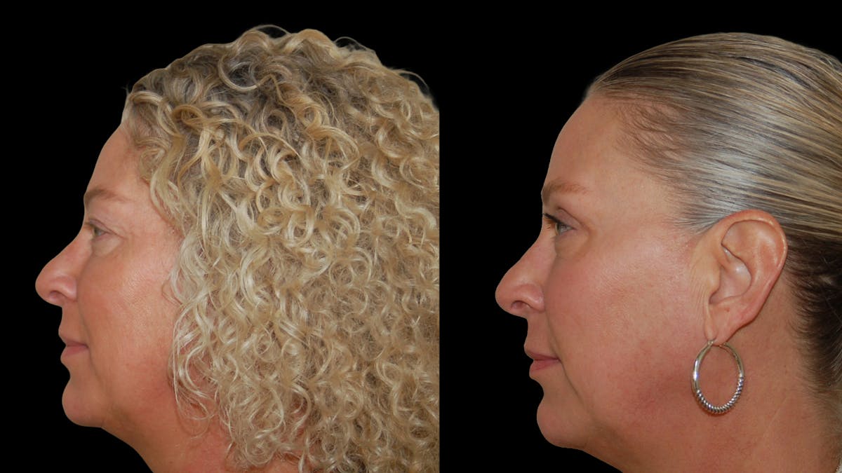 Upper Eyelid Surgery Before & After Gallery - Patient 556963 - Image 3