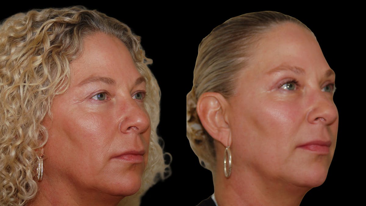 Upper Eyelid Surgery Before & After Gallery - Patient 556963 - Image 4