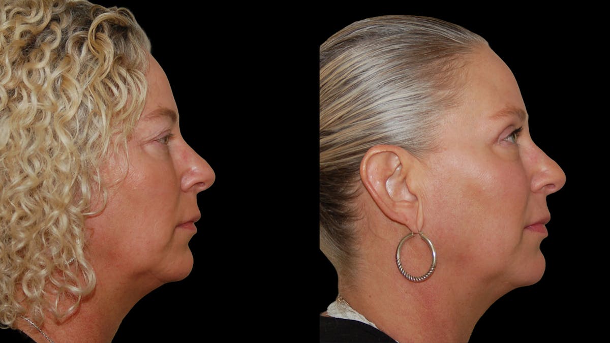 Upper Eyelid Surgery Before & After Gallery - Patient 556963 - Image 5