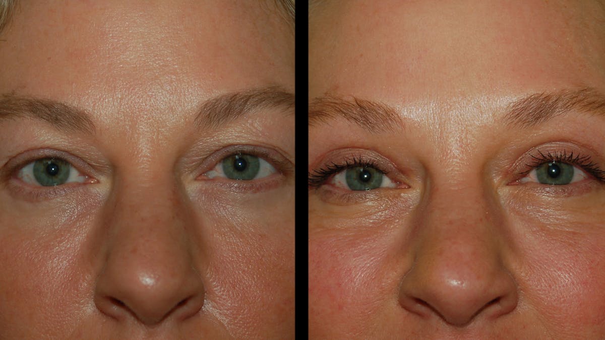 Upper Eyelid Surgery Before & After Gallery - Patient 556963 - Image 6
