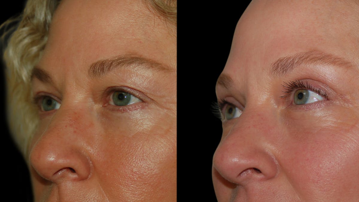 Upper Eyelid Surgery Before & After Gallery - Patient 556963 - Image 7