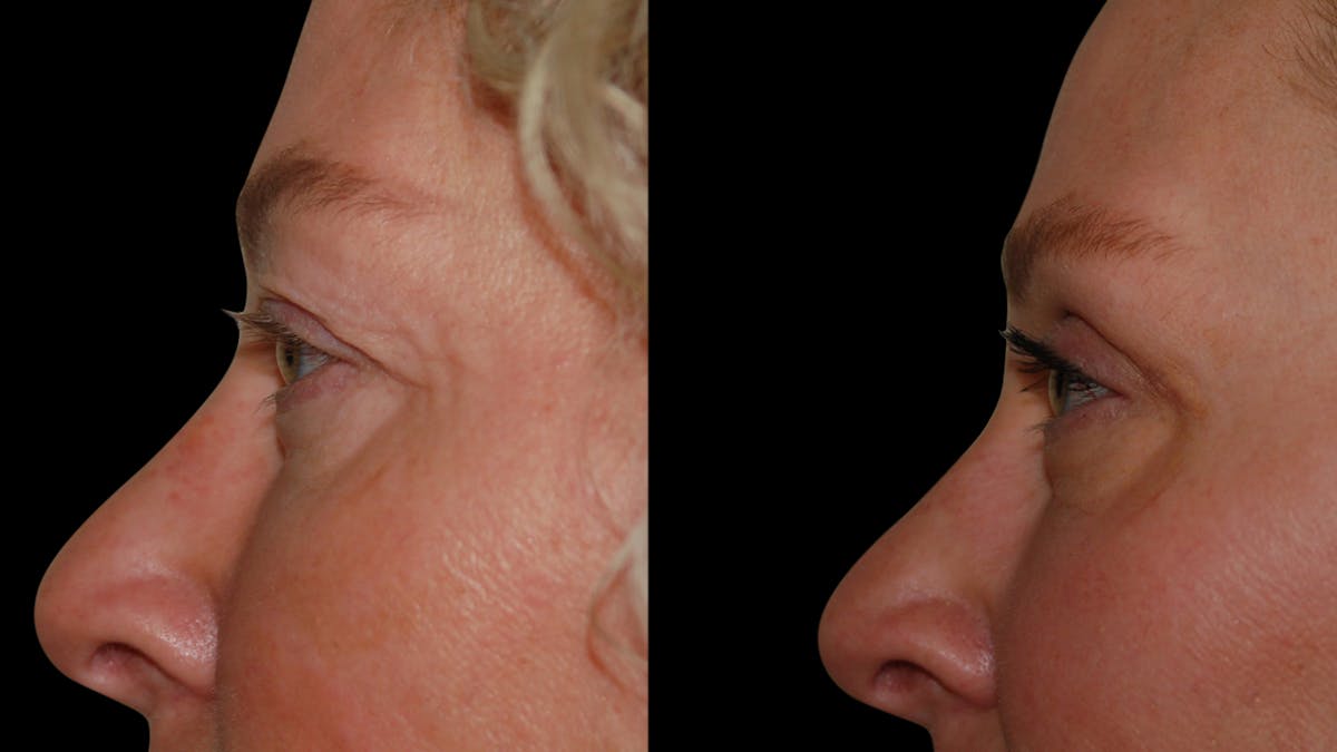Upper Eyelid Surgery Before & After Gallery - Patient 556963 - Image 8