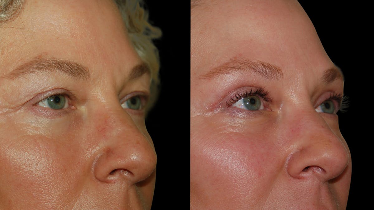 Upper Eyelid Surgery Before & After Gallery - Patient 556963 - Image 9