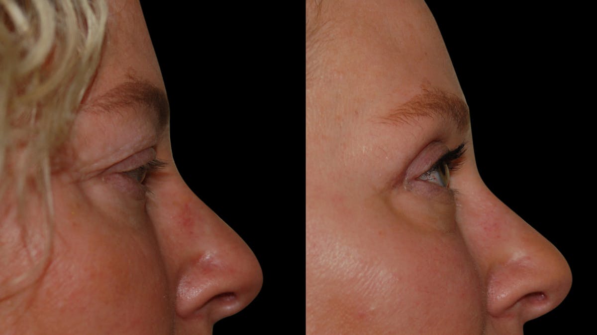 Upper Eyelid Surgery Before & After Gallery - Patient 556963 - Image 10