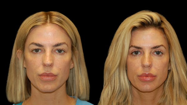 Upper Eyelid Surgery Before & After Gallery - Patient 130707 - Image 1