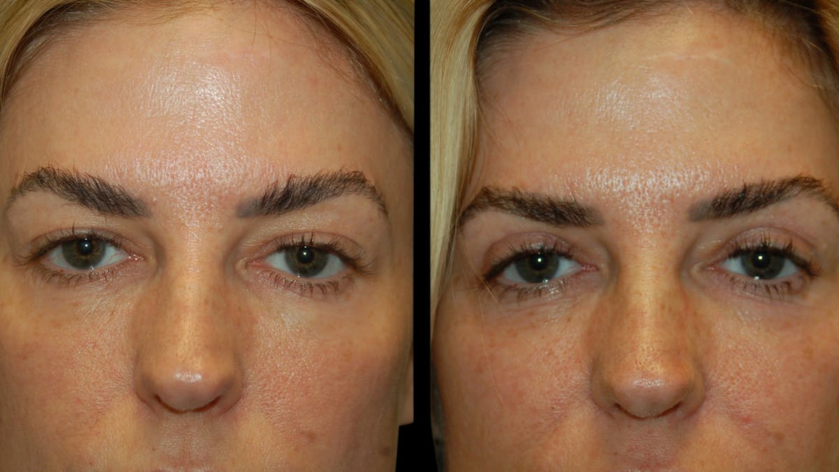Upper Eyelid Surgery Before & After Gallery - Patient 130707 - Image 5