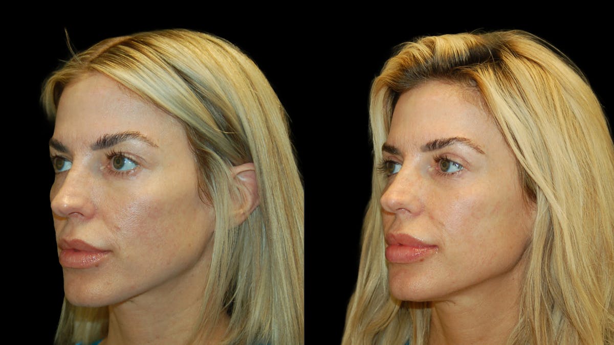Upper Eyelid Surgery Before & After Gallery - Patient 130707 - Image 2