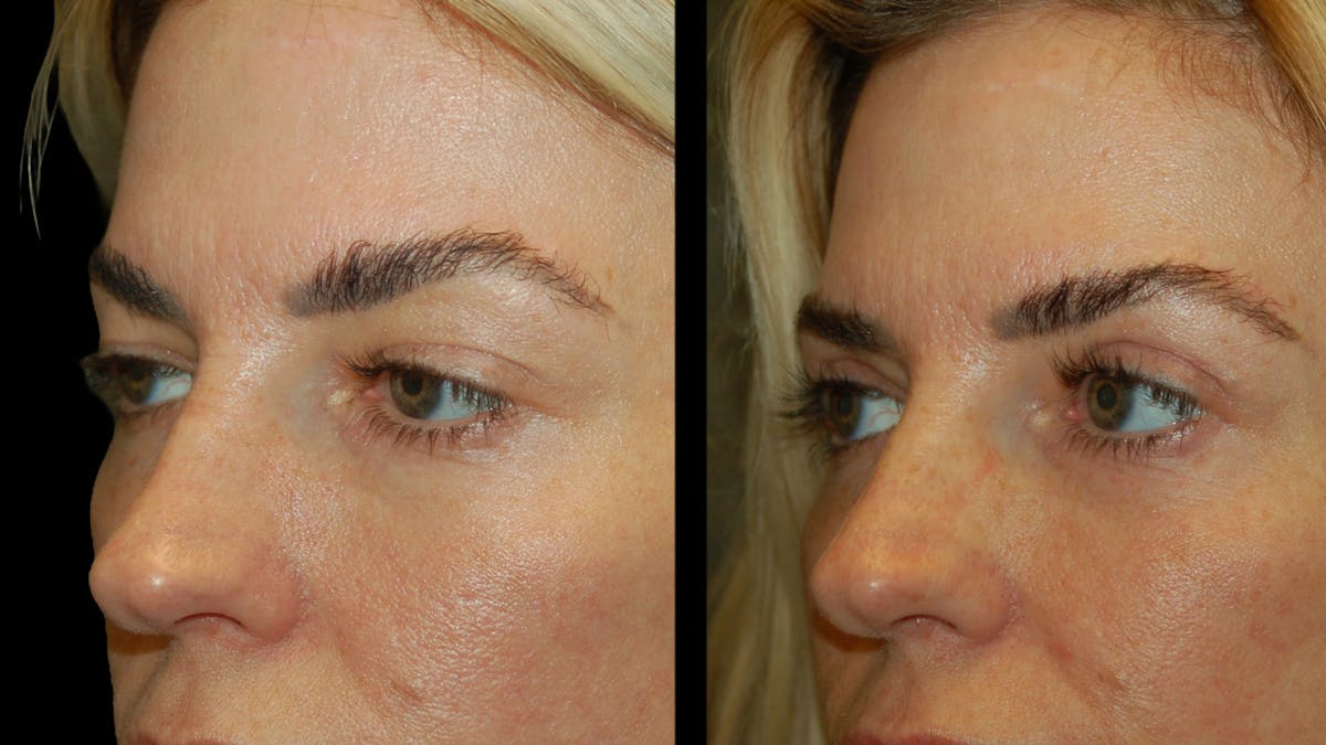 Upper Eyelid Surgery Before & After Gallery - Patient 130707 - Image 6