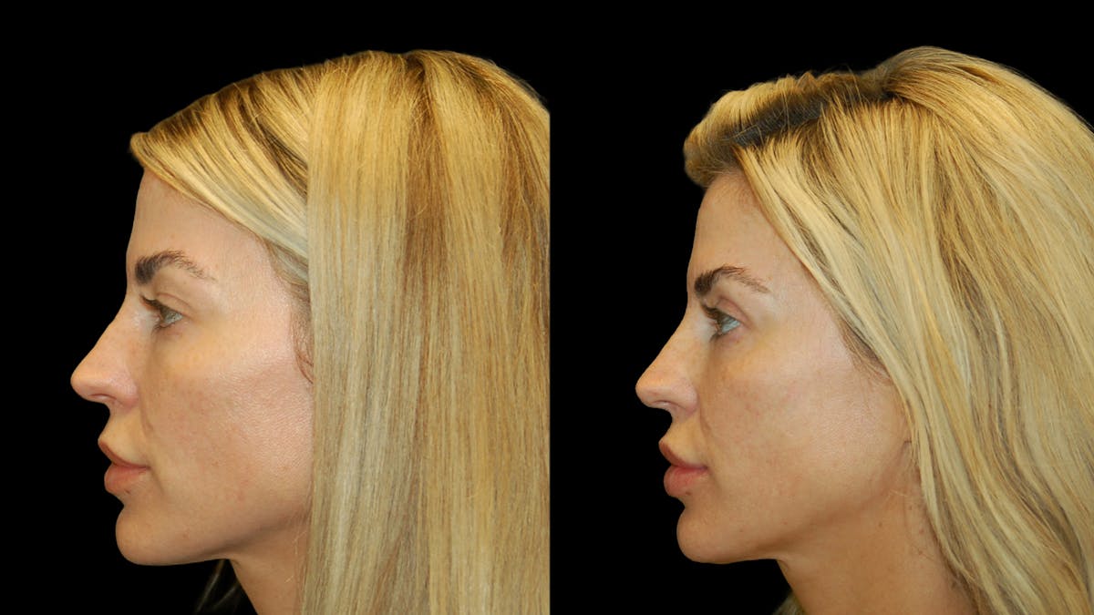 Upper Eyelid Surgery Before & After Gallery - Patient 130707 - Image 3
