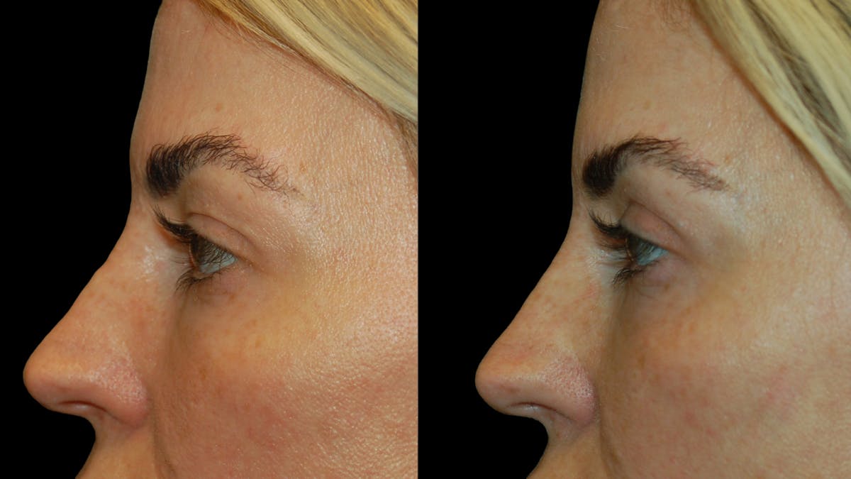 Upper Eyelid Surgery Before & After Gallery - Patient 130707 - Image 7