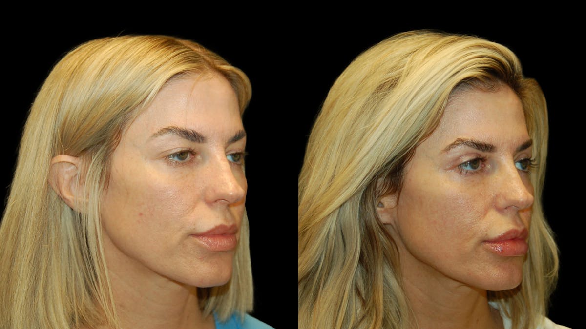 Upper Eyelid Surgery Before & After Gallery - Patient 130707 - Image 4