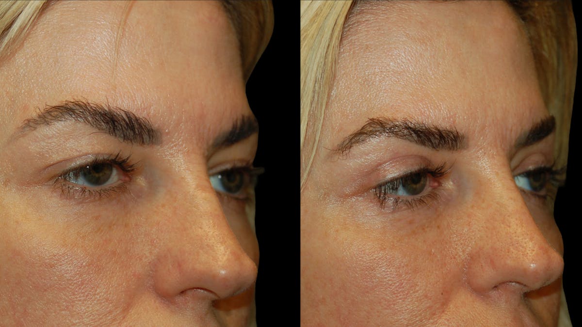 Upper Eyelid Surgery Before & After Gallery - Patient 130707 - Image 8