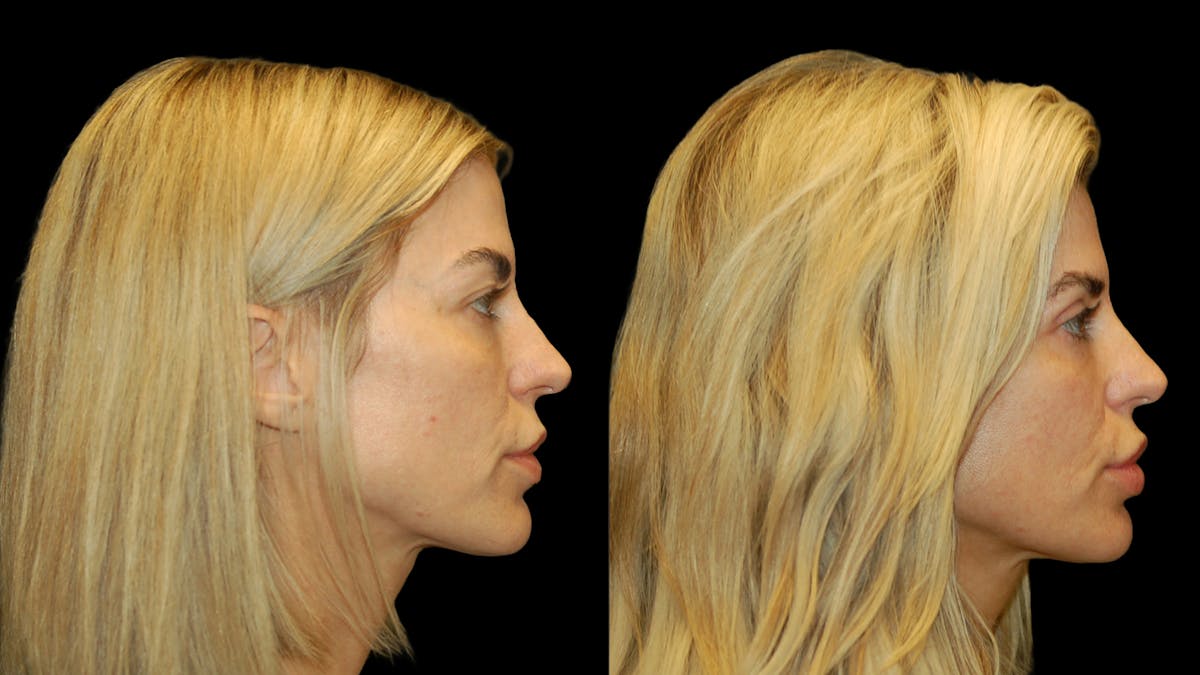 Upper Eyelid Surgery Before & After Gallery - Patient 130707 - Image 9